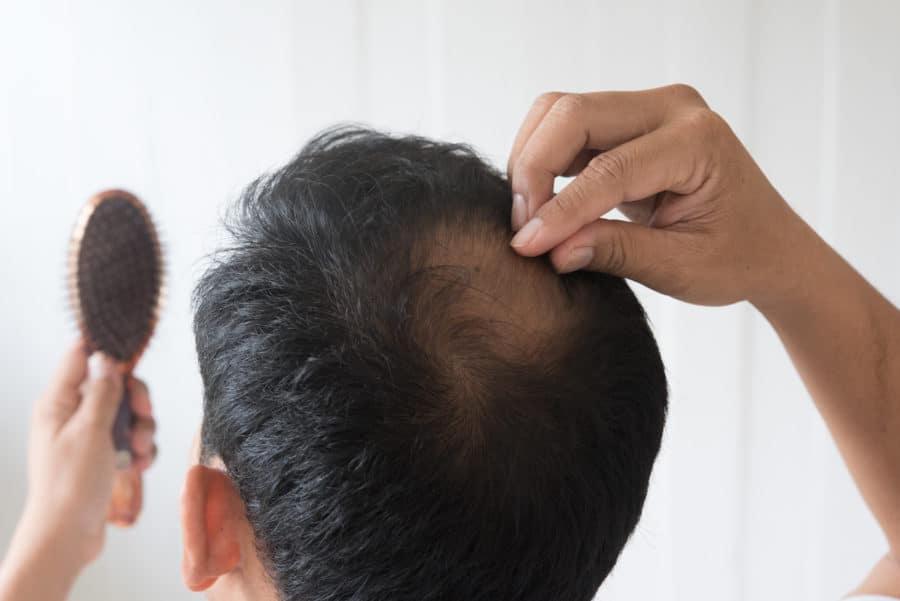 Homem preocupado com queda de cabelo masculino